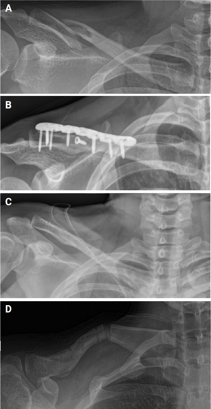 Surgical treatment options of displaced midshaft fractures of the clavicle in young adults: plate fixation versus intramedullary nailing.