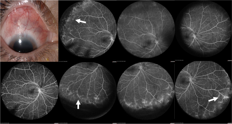 Wide-field fluorescein angiography findings in active anterior scleritis.