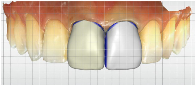 Recent Advances in Intraoral Scanners.