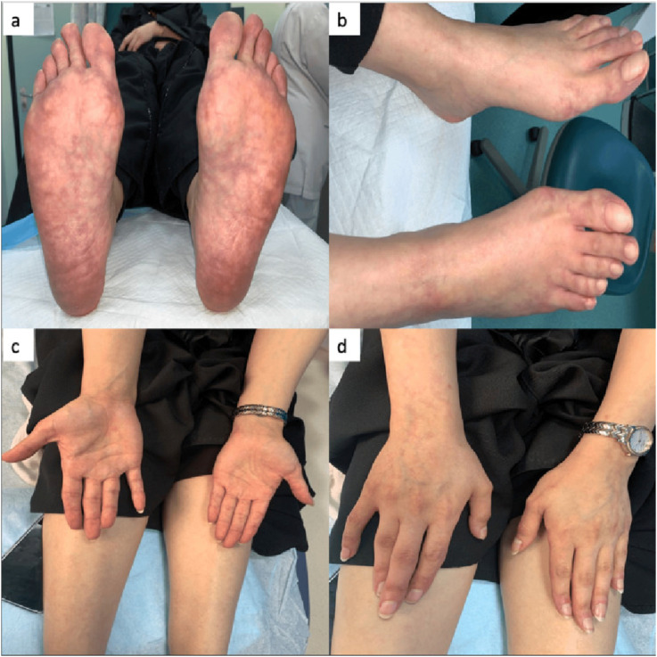 Comprehensive insights of Sneddon syndrome: A clinical perspective.