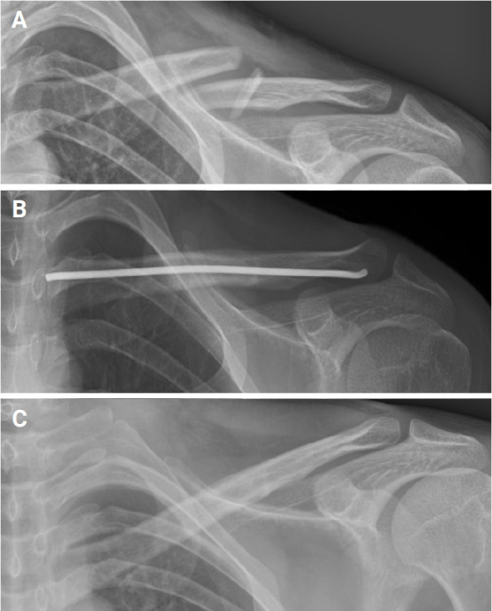 Surgical treatment options of displaced midshaft fractures of the clavicle in young adults: plate fixation versus intramedullary nailing.