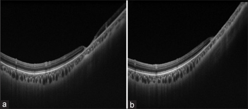 Clinical Features and Outcomes of Cytomegalovirus Retinitis in Immunosuppressed Non-HIV Patients.