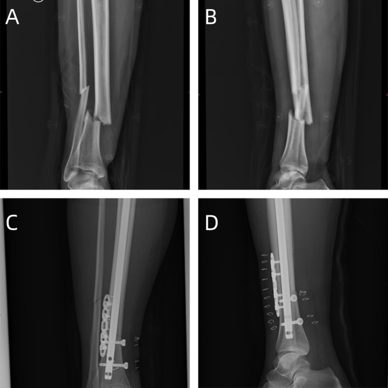 Comparison of the efficacy of intramedullary nailing via the lateral parapatellar approach versus the infrapatellar approach in the treatment of tibial metaphyseal-diaphyseal junction fractures.
