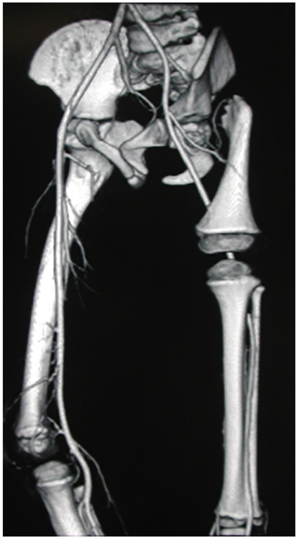 Ankle and foot deformities and malformations in proximal femoral focal deficiency.