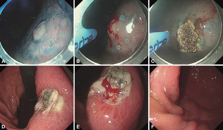 Pathological Evaluation of the Therapeutic Effects of Argon Plasma Coagulation in Gastric Low-Grade Dysplasia.