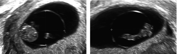 Amniotic sac diameter reference interval in early pregnancy between 7 and 10 weeks' gestation.
