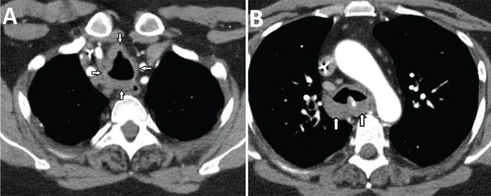 A Rare Cause of Dyspnea in a Patient with Multiple Myeloma: Tracheobronchial Amyloidosis
