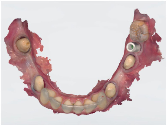 Recent Advances in Intraoral Scanners.
