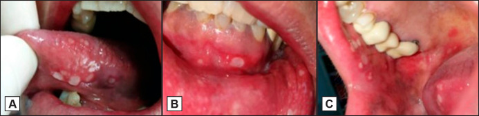 Aphthous-Like Stomatitis in a Patient Receiving Panitumumab.