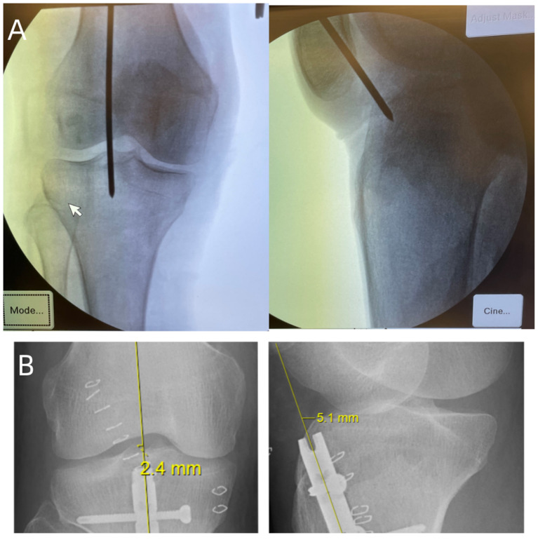 Comparison of the efficacy of intramedullary nailing via the lateral parapatellar approach versus the infrapatellar approach in the treatment of tibial metaphyseal-diaphyseal junction fractures.