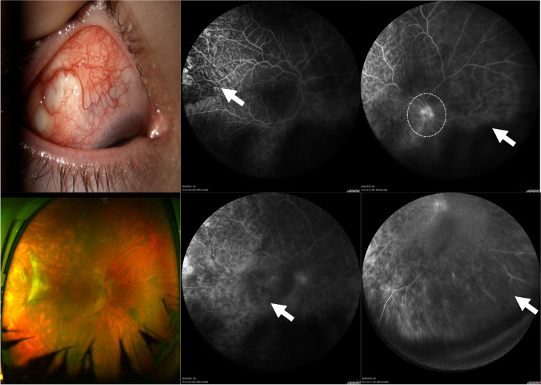Wide-field fluorescein angiography findings in active anterior scleritis.