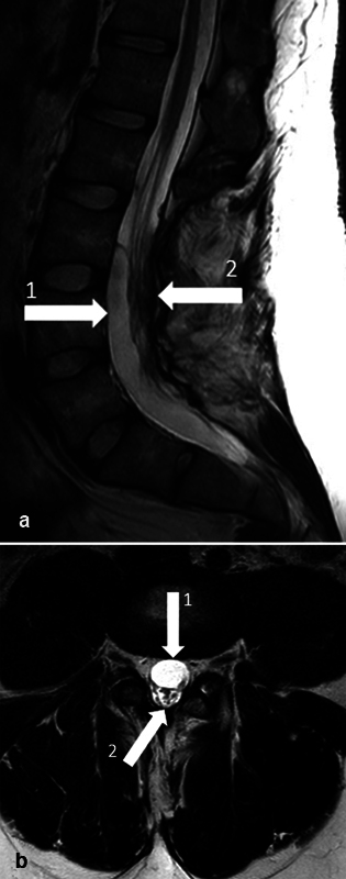 Arachnoid Cyst as a Late Complication of Selective Dorsal Rhizotomy: A Case Report.