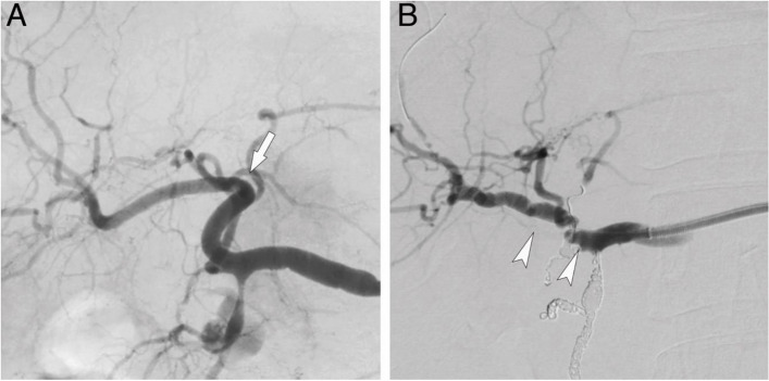 Hepatic artery stenting with Viabahn.