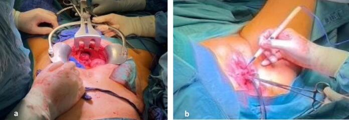 Gracilis flap and partial colpocleisis of Kahr for pelvic organ prolapse after anterior exenteration: A case report