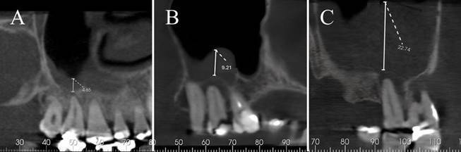 Association of Maxillary Sinus Reactions and Periapical Pathology in the Maxillary Posterior Teeth: Evaluation Using Cone Beam Computed Tomography.