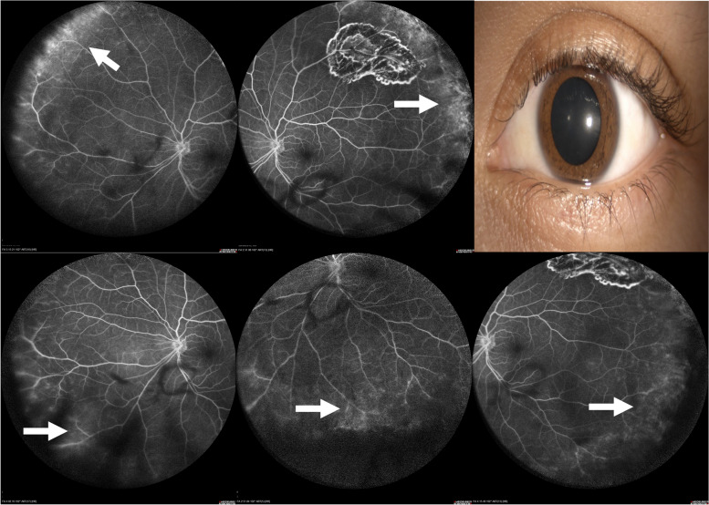 Wide-field fluorescein angiography findings in active anterior scleritis.