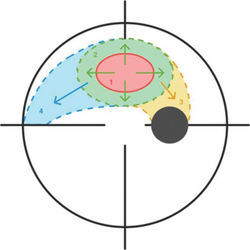 Visual field patterns in glaucoma: A systematic review.