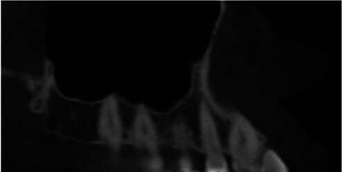 Association of Maxillary Sinus Reactions and Periapical Pathology in the Maxillary Posterior Teeth: Evaluation Using Cone Beam Computed Tomography.