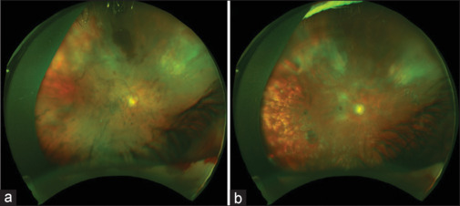 Clinical Features and Outcomes of Cytomegalovirus Retinitis in Immunosuppressed Non-HIV Patients.