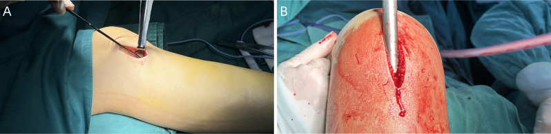Comparison of the efficacy of intramedullary nailing via the lateral parapatellar approach versus the infrapatellar approach in the treatment of tibial metaphyseal-diaphyseal junction fractures.