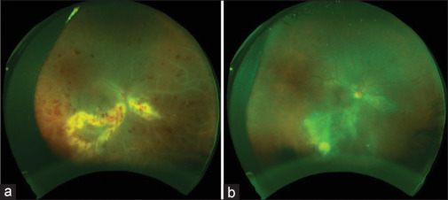 Clinical Features and Outcomes of Cytomegalovirus Retinitis in Immunosuppressed Non-HIV Patients.