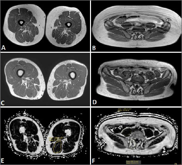 Impact of bariatric surgery on clinical outcome in LOPD.