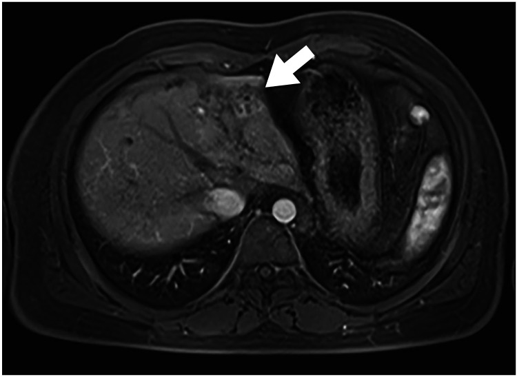 Surgical treatment for intractable cholangitis with intrahepatic biliary cysts followed by Kasai operation in biliary atresia: a retrospective cohort study.