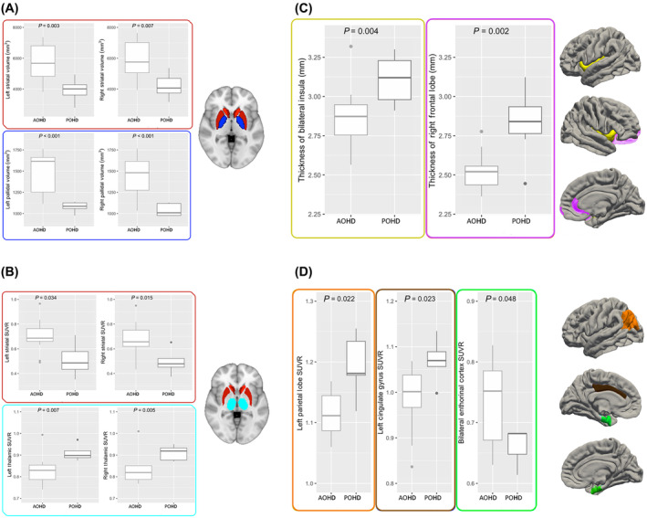 Pediatric Huntington Disease Brains Have Distinct Morphologic and Metabolic Traits: the RAREST-JHD Study.