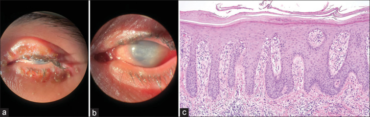 Severe Psoriasiform Blepharitis Accompanying with Phthisis Bulbi.