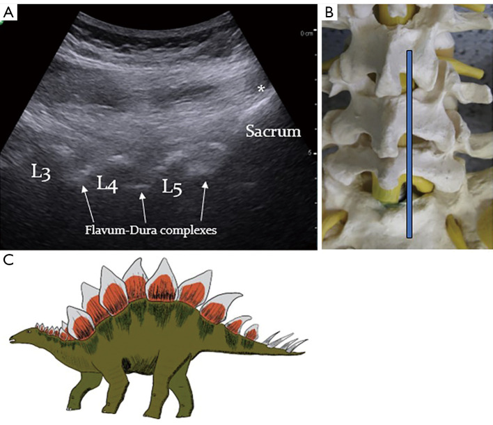 'The Stegosaurus Appearance' on ultrasound to assist in identifying the correct spinal level for primary lumbar spinal surgery.