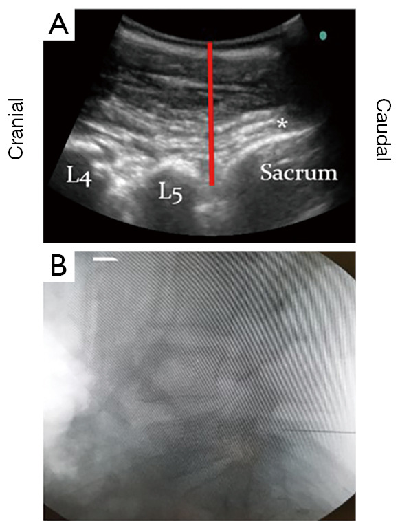 'The Stegosaurus Appearance' on ultrasound to assist in identifying the correct spinal level for primary lumbar spinal surgery.