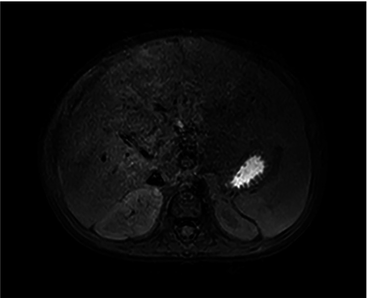 Surgical treatment for intractable cholangitis with intrahepatic biliary cysts followed by Kasai operation in biliary atresia: a retrospective cohort study.
