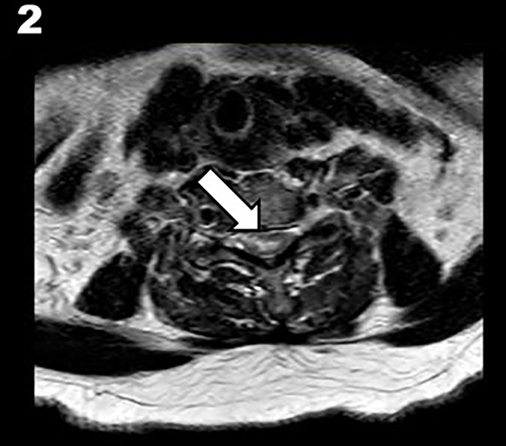 Systemic intravenous thrombolysis and spinal stroke: a case report and review of the literature.