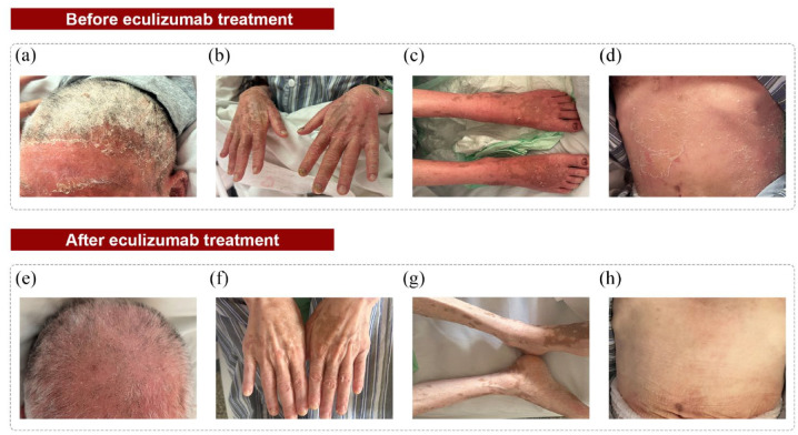 Eculizumab in thymoma-associated myasthenia gravis: a real-world cohort study.