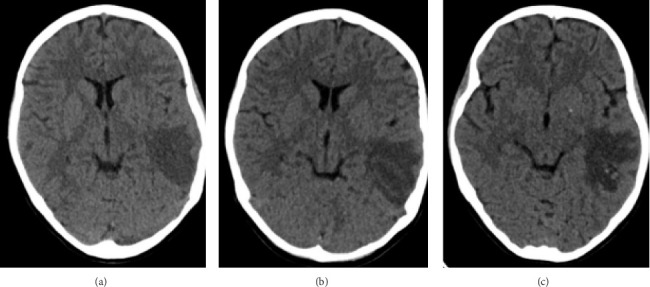 Aseptic Meningitis and White Matter Disease in Childhood-Onset Neuropsychiatric Lupus.