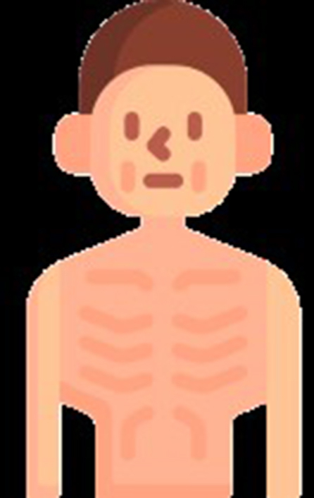Malnutrition in adult patients treated with venoarterial extracorporeal membrane oxygenation: A descriptive cohort study