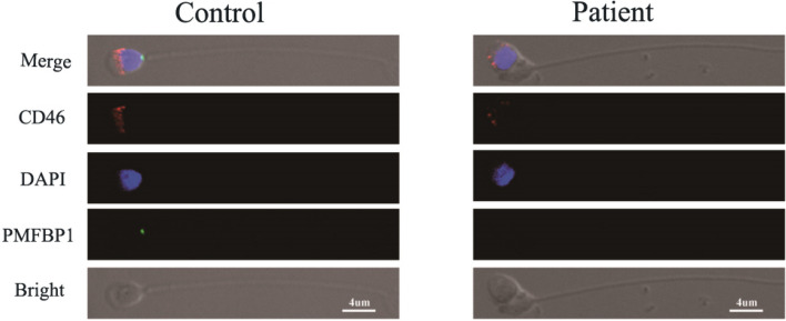 Pathogenesis of acephalic spermatozoa syndrome caused by PMFBP1 mutation.