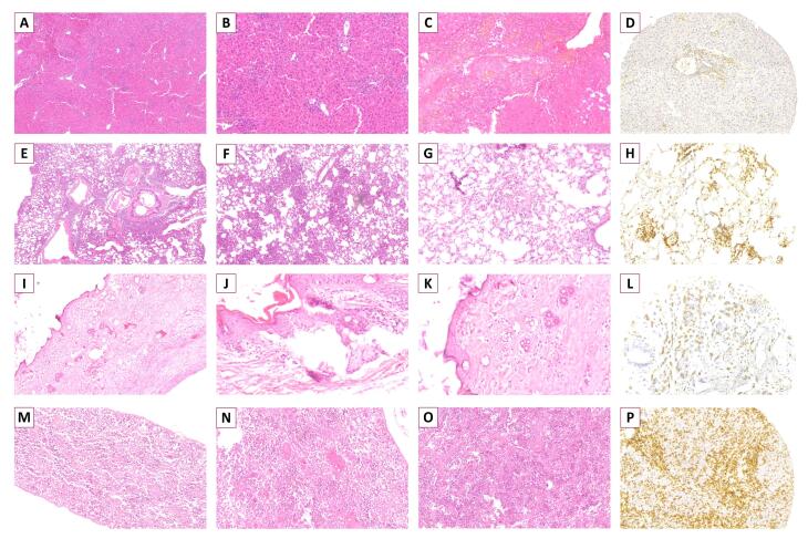 Clinicopathologic Effects of Xenogeneic GvHD Induced by Adoptively Transferred Human-Derived T Cells in Severely Immunodeficient Mice.