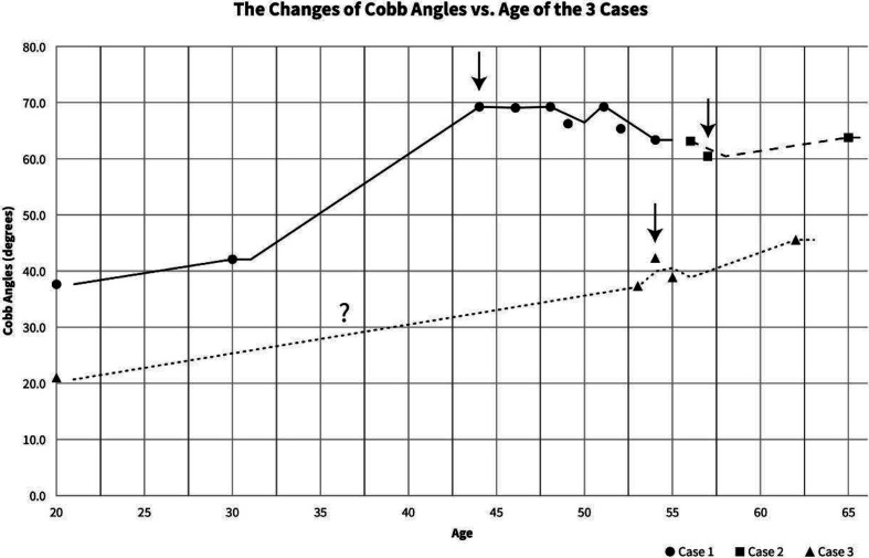 Impact of scoliosis-specific exercises in moderate to severe thoracolumbar curves in three postmenopausal women.