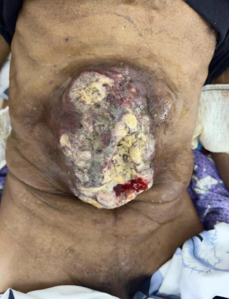 Abdominal parietal metastasis on operative scar of gastric adenocarcinoma after R0 resection: An unusual location (about a case).