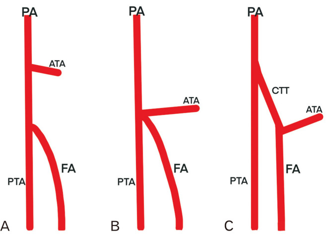 A rare variation in popliteal artery branching: anterior tibial artery and fibular artery from the common tibiofibular trunk.