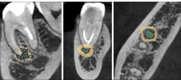 Radiomic Parameters in Periapical Lesions: A CBCT Analysis Evaluating Volumetric Size, Cortical Expansion, Erosion, and Shape.