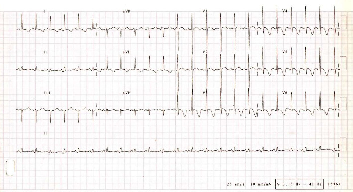 <i>A De Novo</i> Mutation in <i>ACTC1</i> and a <i>TTN</i> Variant Linked to a Severe Sporadic Infant Dilated Cardiomyopathy Case.