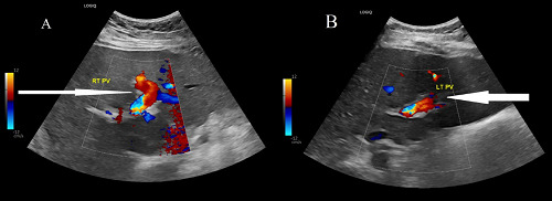 Portal vein thrombosis in a patient on semaglutide.