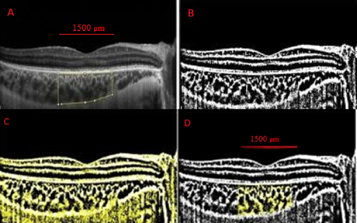 Choroidal and Retinal OCTA Parameters after Scleral Buckling.