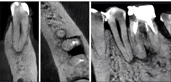 Radiomic Parameters in Periapical Lesions: A CBCT Analysis Evaluating Volumetric Size, Cortical Expansion, Erosion, and Shape.