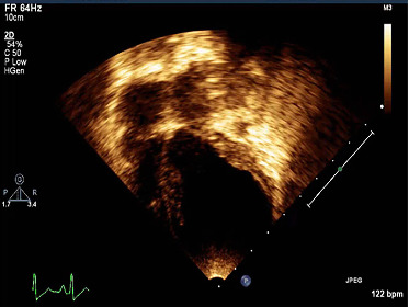 <i>A De Novo</i> Mutation in <i>ACTC1</i> and a <i>TTN</i> Variant Linked to a Severe Sporadic Infant Dilated Cardiomyopathy Case.