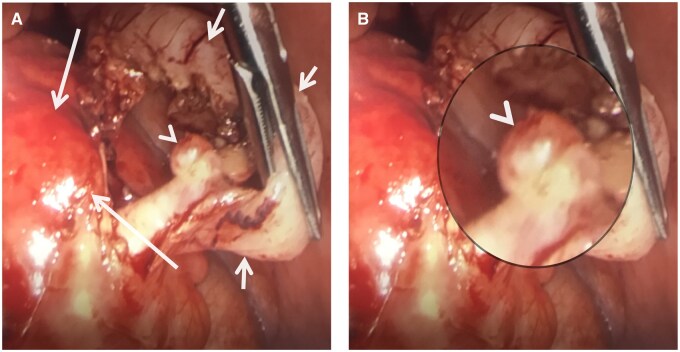 Appendiceal diverticulitis: a rare pathology disguised as acute appendicitis.
