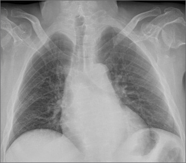 Severe progressive respiratory involvement requiring ventilator support in autosomal recessive Bethlem myopathy. A case report.