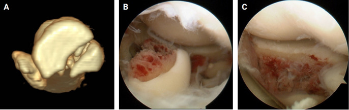 Is partial excision of the radial head safe and effective in all-arthroscopic treatment of terrible triad fractures?
